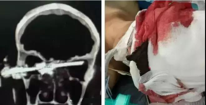 当场死亡！又是砂轮机事故：不装防护罩的砂轮机就是杀人机！石材行业注意防护！