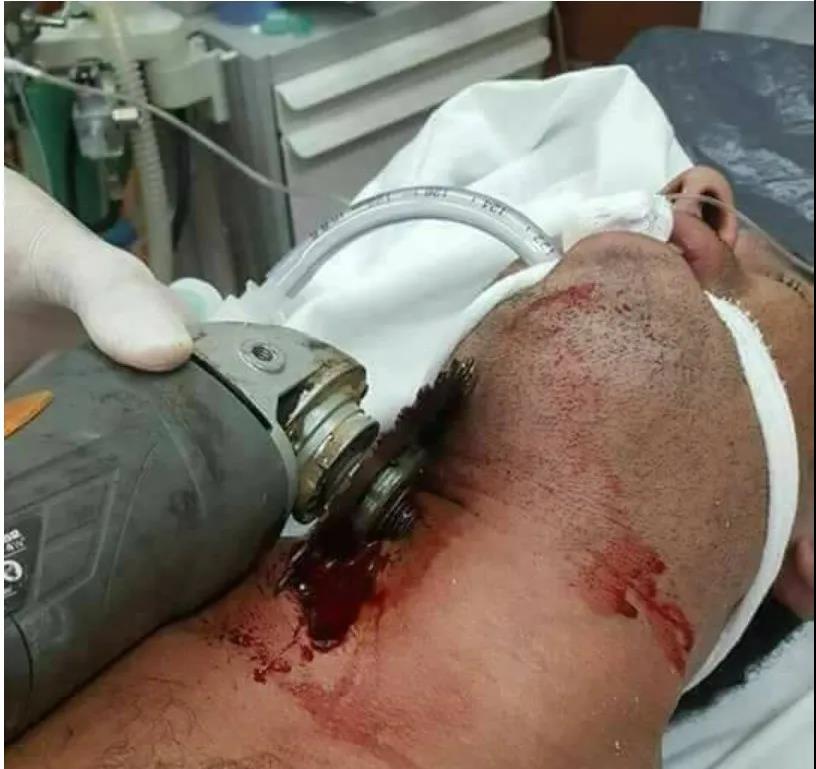 当场死亡！又是砂轮机事故：不装防护罩的砂轮机就是杀人机！石材行业注意防护！